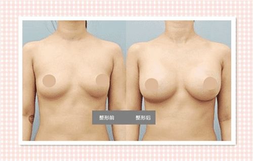 隆胸手术效果真的如宣传所说吗？看看这些真实案例图片，效果究竟如何？