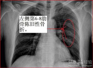 打架轻微伤赔偿标准是多少？眼睛受伤或肋骨骨折该如何赔偿？