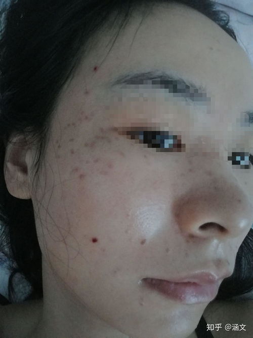 开设点痣祛斑店，真的能实现盈利吗？